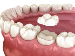 All-Ceramic Crowns